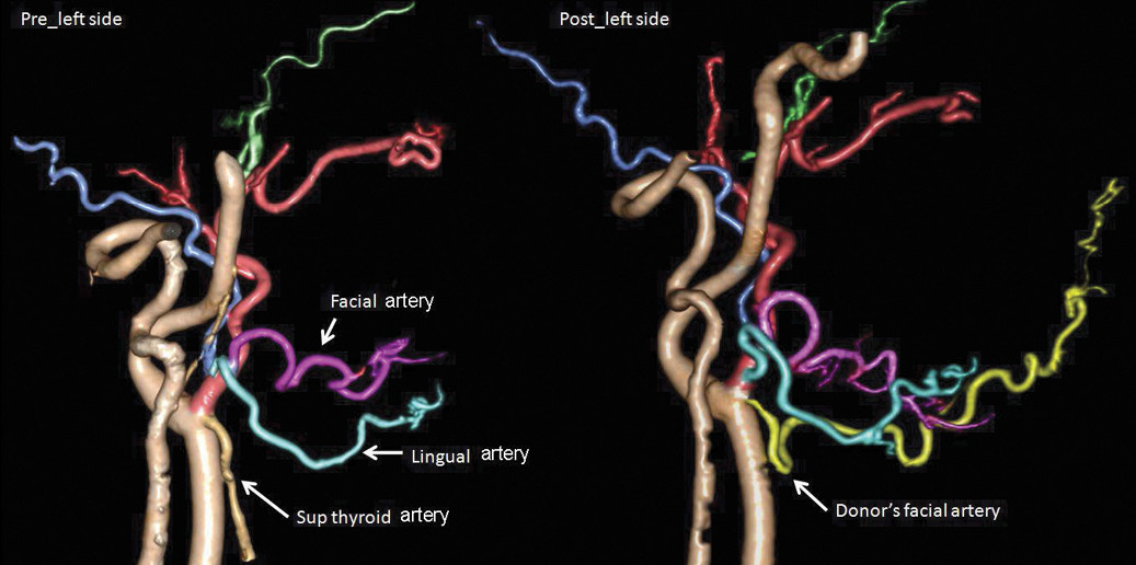 CT angiography before and after face transplantation